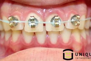 DIY Braces Dangers: Straight Teeth Alternatives? The DIY Hub: Creative Crafts, Repairs & Life Hacks DIY Braces Dangers: Straight Teeth Alternatives? | The DIY Hub: Creative Crafts, Repairs & Life Hacks