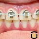 DIY Braces Dangers: Straight Teeth Alternatives? | The DIY Hub: Creative Crafts, Repairs & Life Hacks